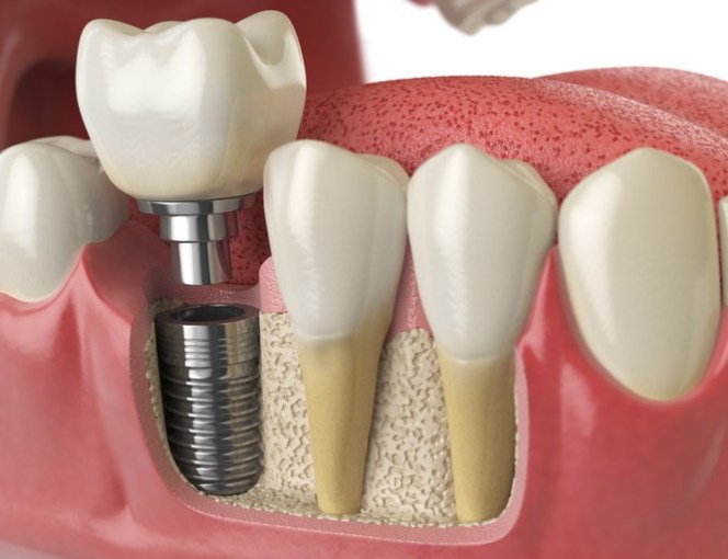 Anatomy of healthy teeth and tooth dental implant in human denturra.