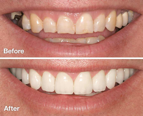 smile-makeover-before-and-after-2